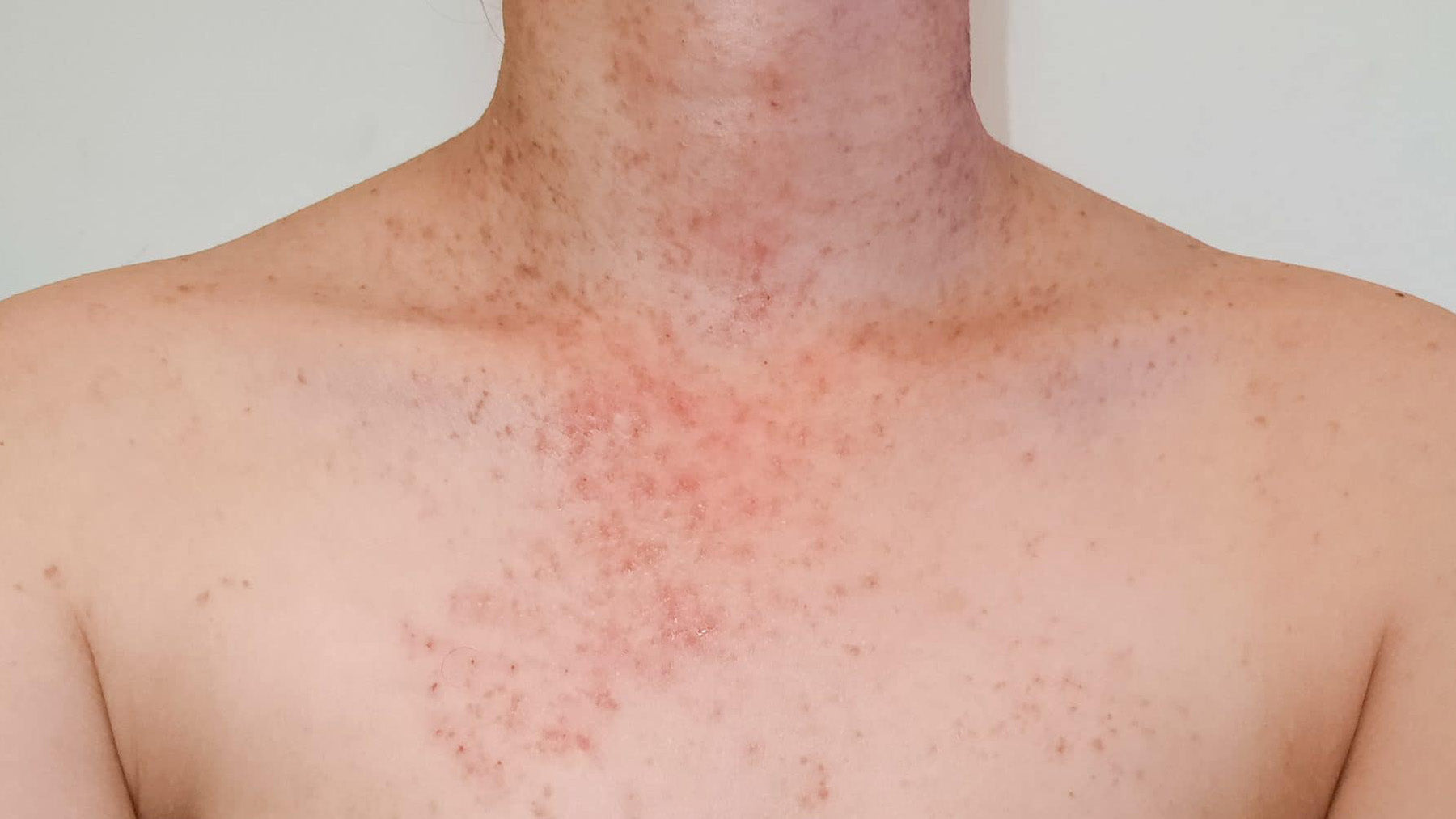 Combatting Folliculitis: Achieve Clearer, Healthier Skin with Audaja